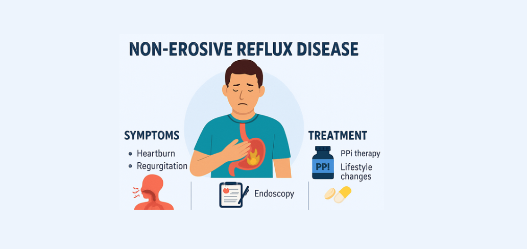 man suffering from non-erosive reflux disease